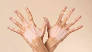 Vitiligo: Activos que le favorecen y sus cuidados